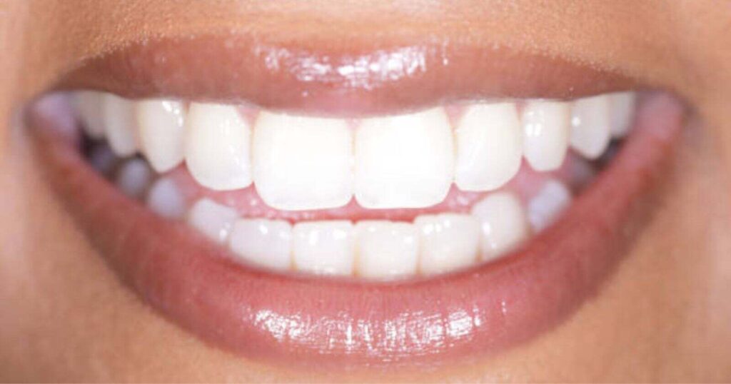 how to reduce gap between teeth naturally at home